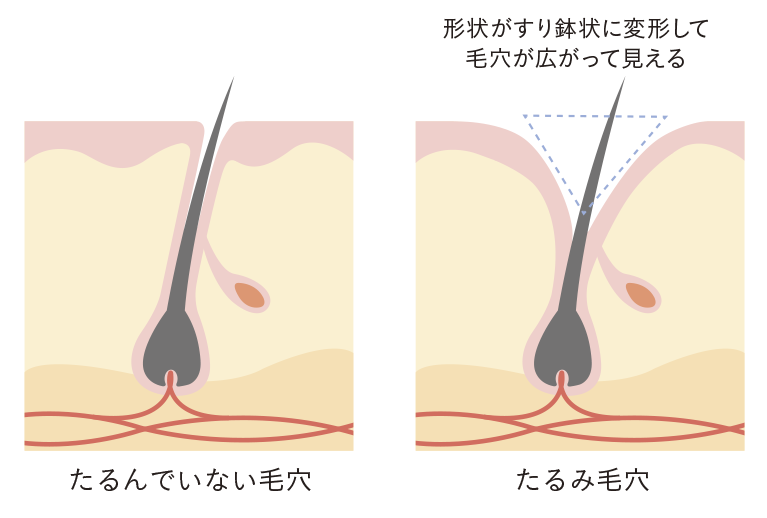 たるみ毛穴(イメージ) たるみ毛穴(イメージ)